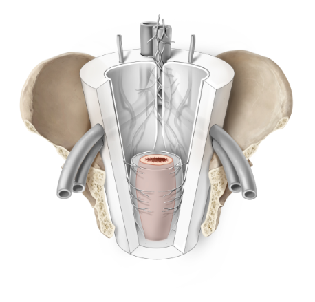 tekening colorectale tumoren