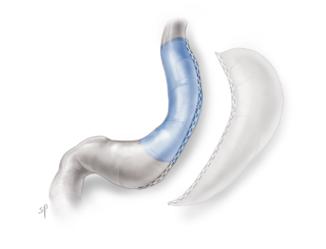 tekening de sleeve gastrctomie