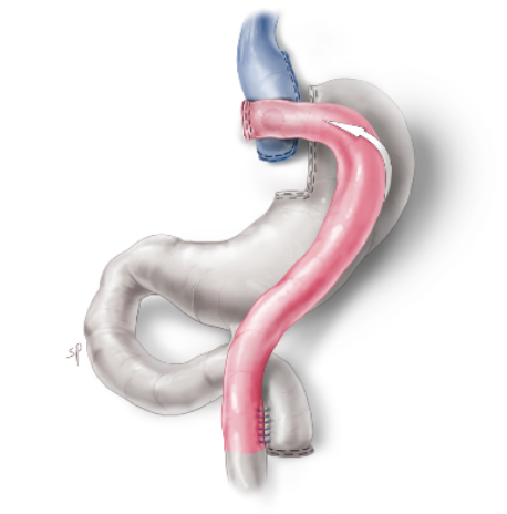 tekening gastric bypass