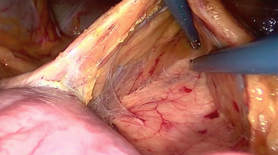 foto tijdens operatie